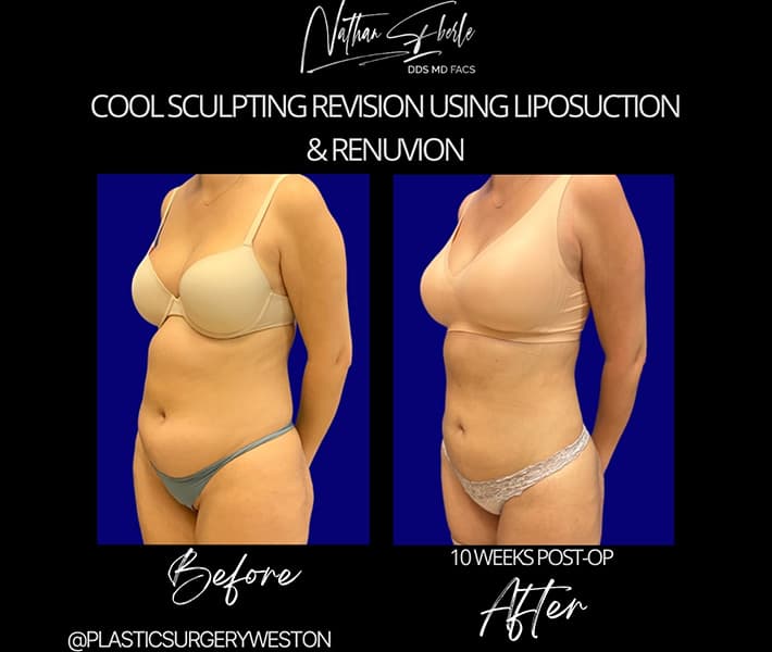 Liposuction before and after - Actual Patient