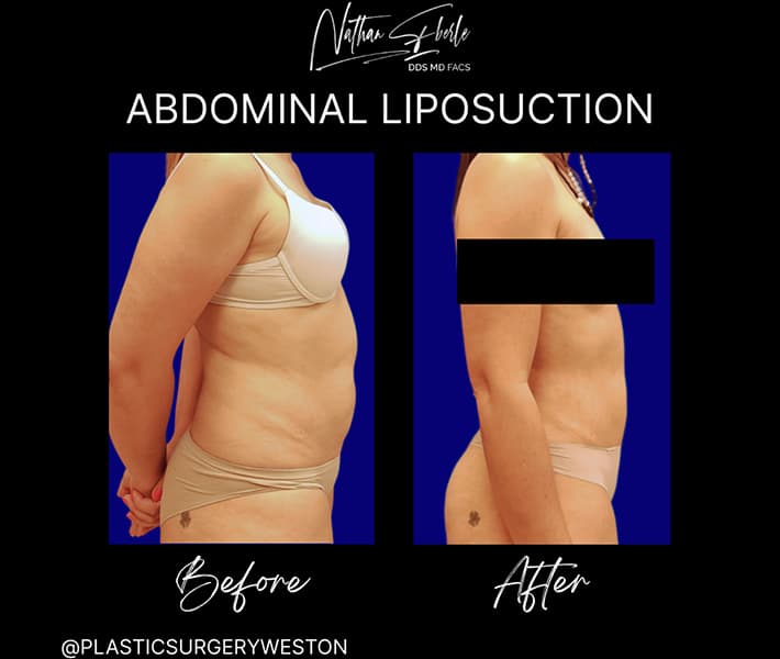 Liposuction before and after - Actual Patient