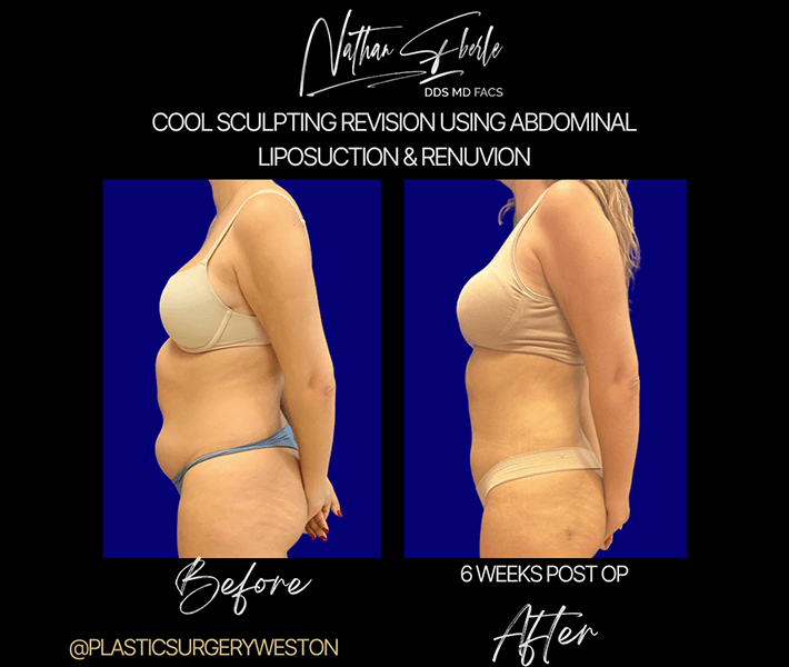 Liposuction before and after - Actual Patient