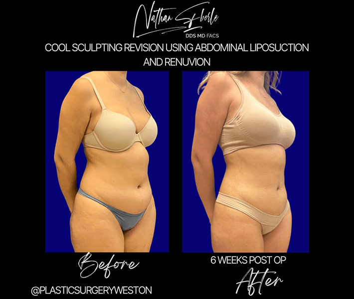 Liposuction before and after - Actual Patient