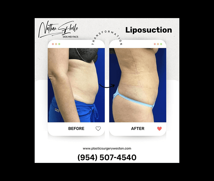 Liposuction before and after - Actual Patient