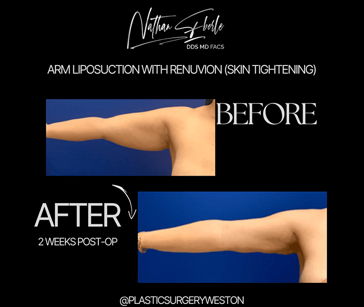 Liposuction before and after - Actual Patient