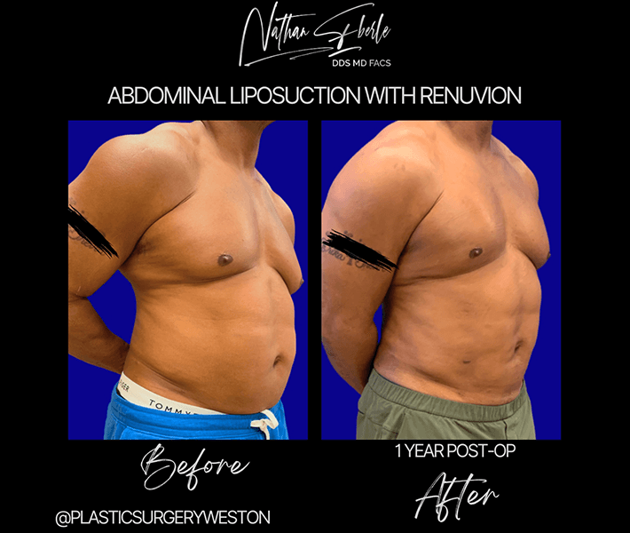 Liposuction before and after - Actual Patient