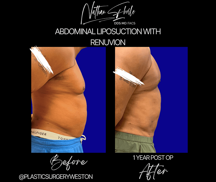 Liposuction before and after - Actual Patient