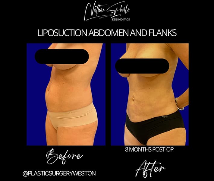 Liposuction before and after - Actual Patient