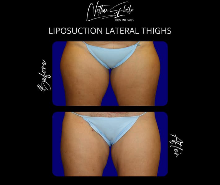 Liposuction before and after - Actual Patient