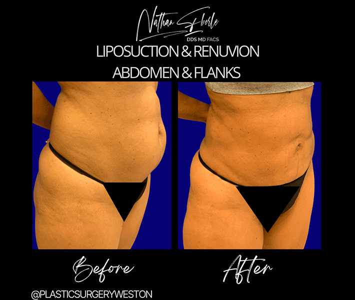 Liposuction before and after - Actual Patient