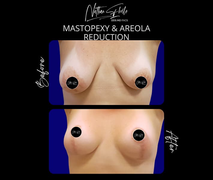 Mastopexy before and after - Actual Patient