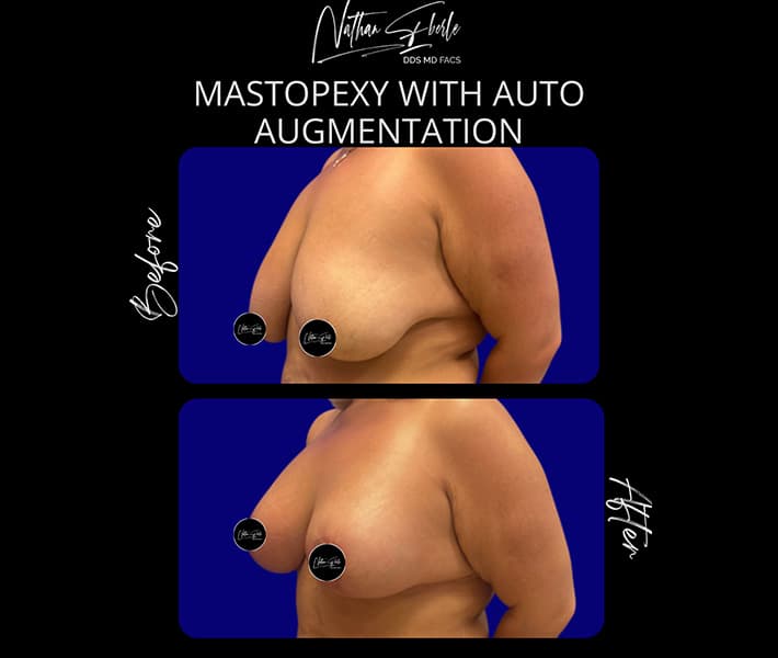 Mastopexy before and after - Actual Patient