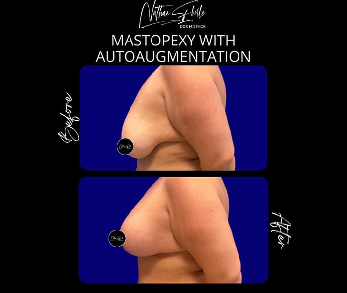 Mastopexy before and after - Actual Patient