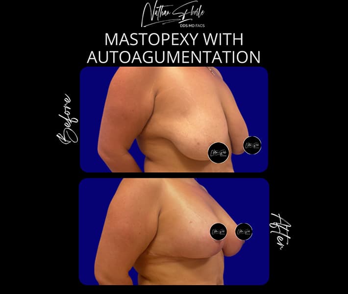 Mastopexy before and after - Actual Patient