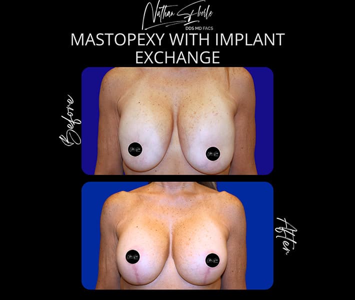 Mastopexy before and after - Actual Patient