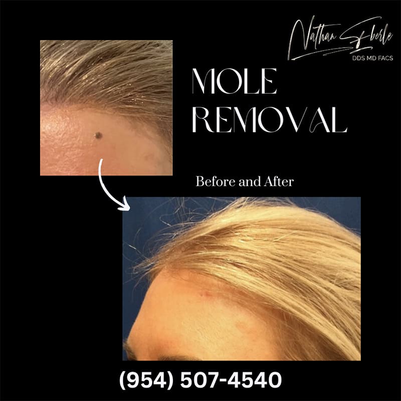 Mole Removal before and after - Actual Patient