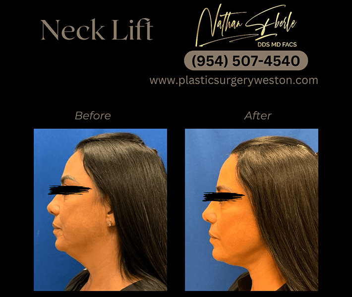 Neck Lift before and after - Actual Patient