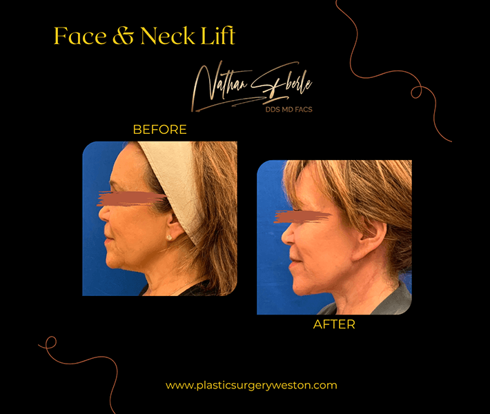 Neck Lift before and after - Actual Patient