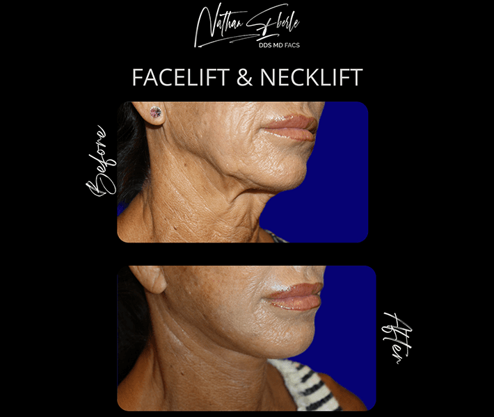 Neck Lift before and after - Actual Patient
