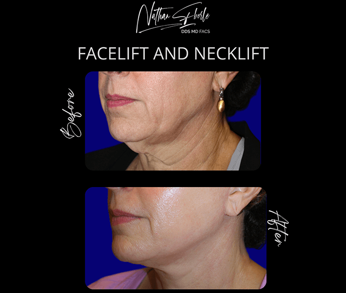 Neck Lift before and after - Actual Patient