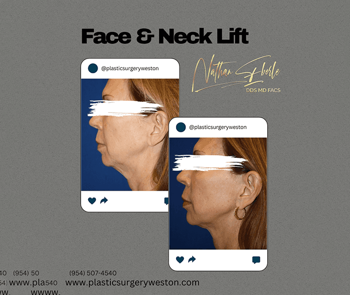 Neck Lift before and after - Actual Patient