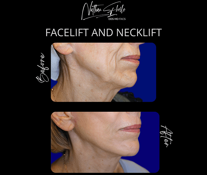Neck Lift before and after - Actual Patient