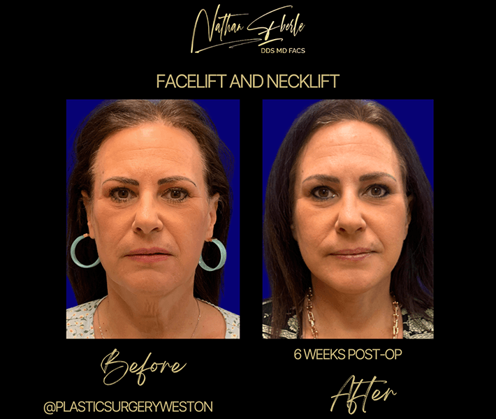 Neck Lift before and after - Actual Patient