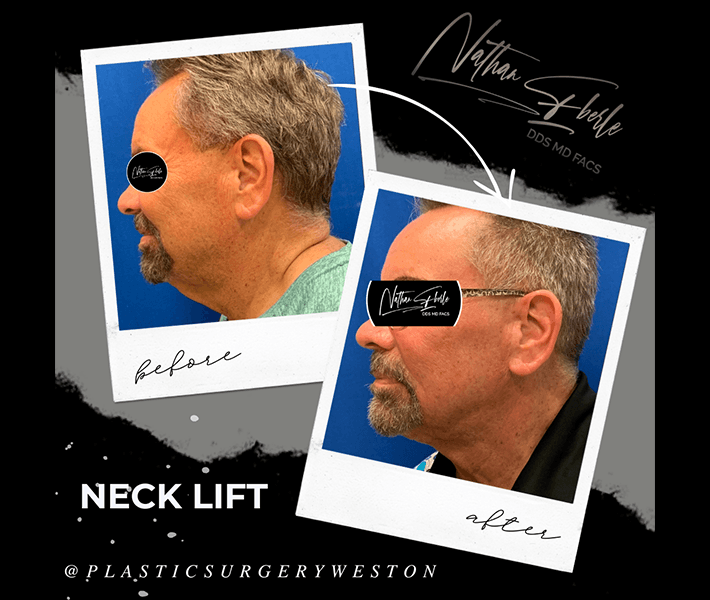 Neck Lift before and after - Actual Patient
