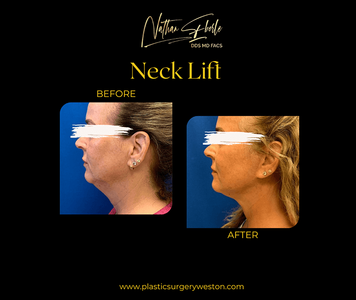 Neck Lift before and after - Actual Patient