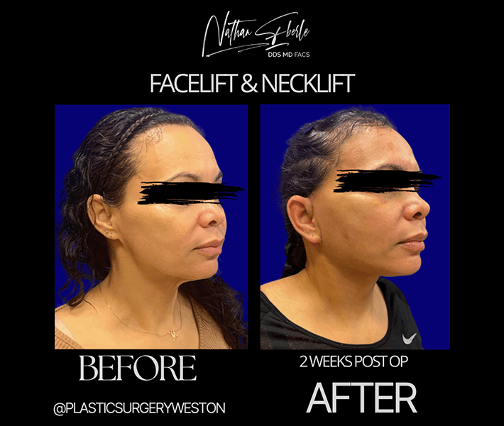 Neck Lift before and after - Actual Patient