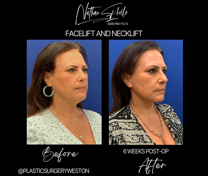 Neck Lift before and after - Actual Patient