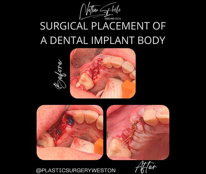 Oral Surgical Placement of Implant before and after - Actual Patient