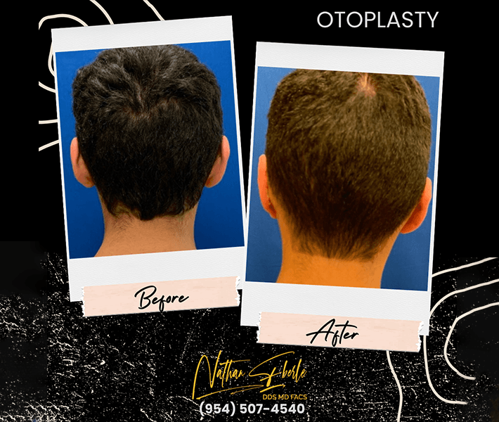 Otoplasty before and after - Actual Patient