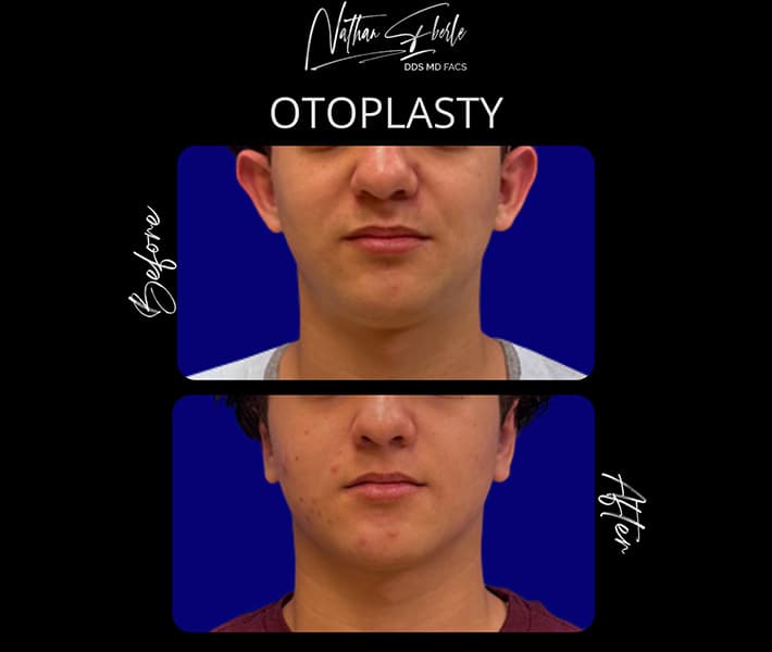 Otoplasty before and after - Actual Patient