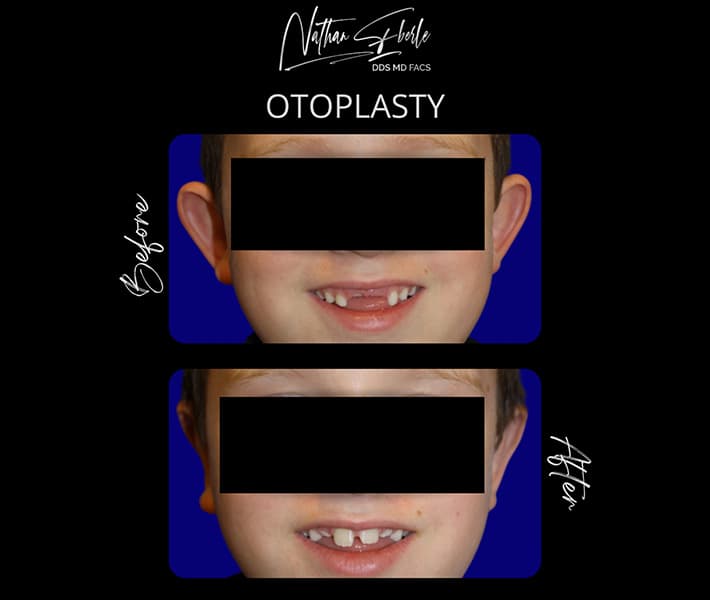 Otoplasty before and after - Actual Patient