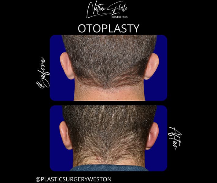 Otoplasty before and after - Actual Patient