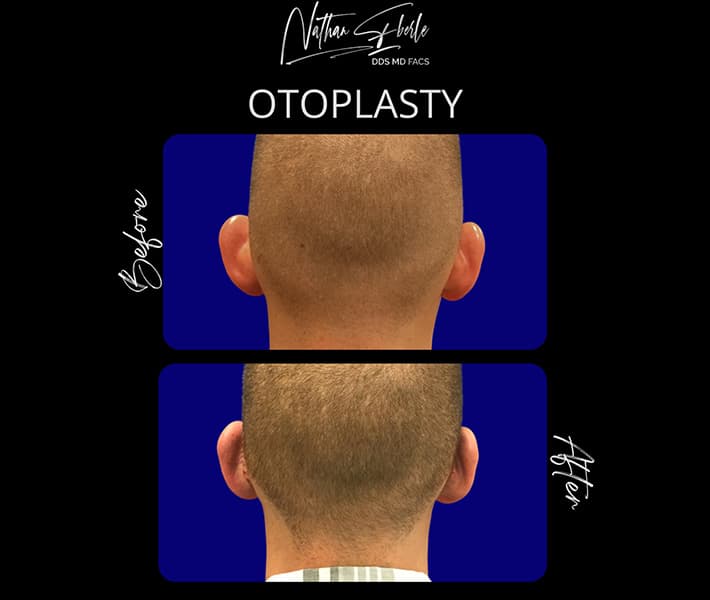 Otoplasty before and after - Actual Patient