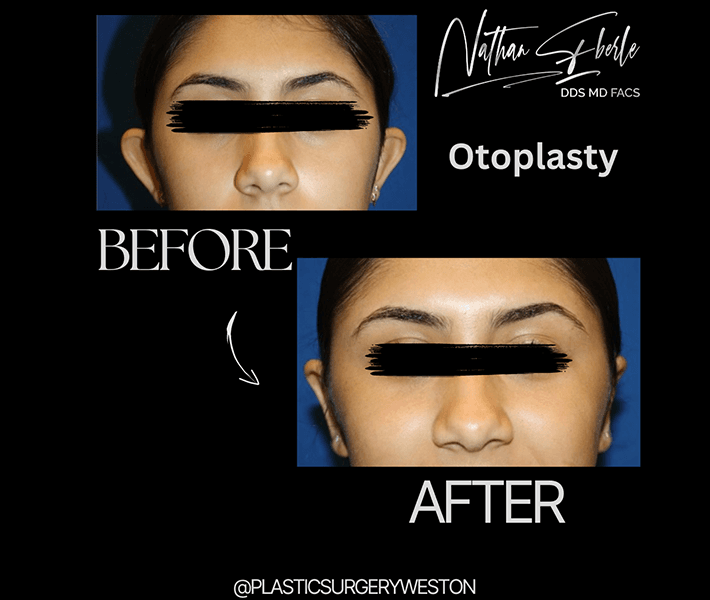 Otoplasty before and after - Actual Patient