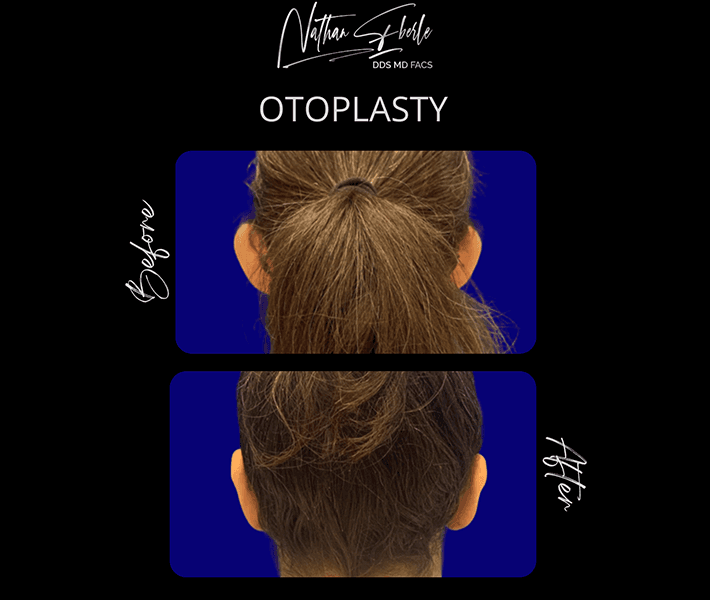 Otoplasty before and after - Actual Patient