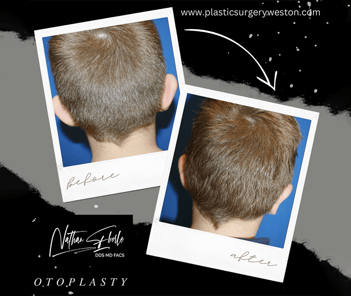 Otoplasty before and after - Actual Patient