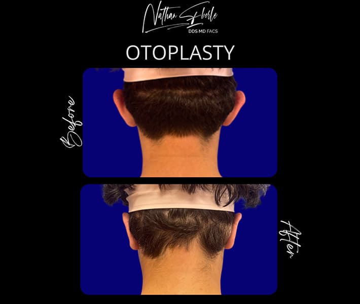 Otoplasty before and after - Actual Patient