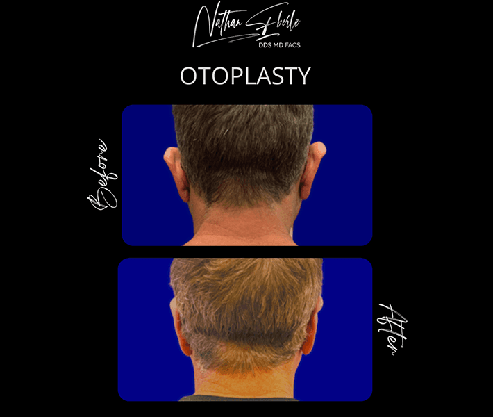 Otoplasty before and after - Actual Patient