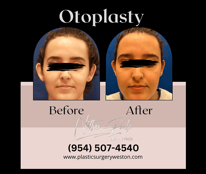 Otoplasty before and after - Actual Patient