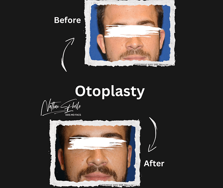 Otoplasty before and after - Actual Patient