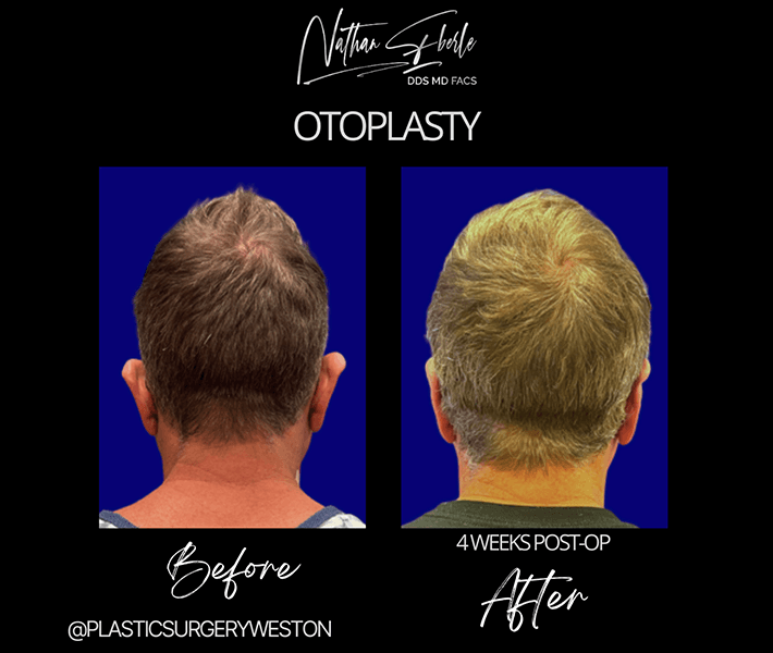 Otoplasty before and after - Actual Patient