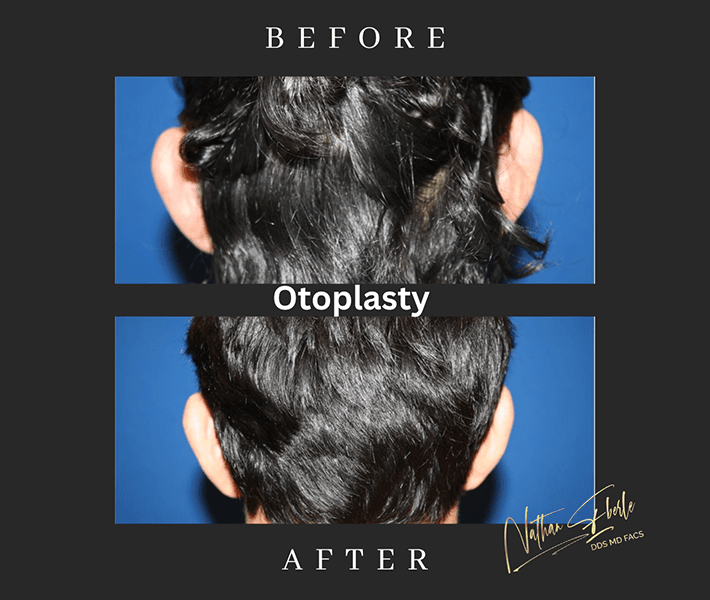Otoplasty before and after - Actual Patient