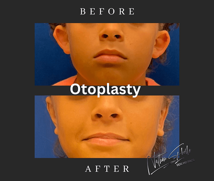 Otoplasty before and after - Actual Patient