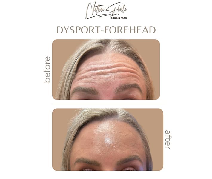 Toxin before and after - Actual Patient