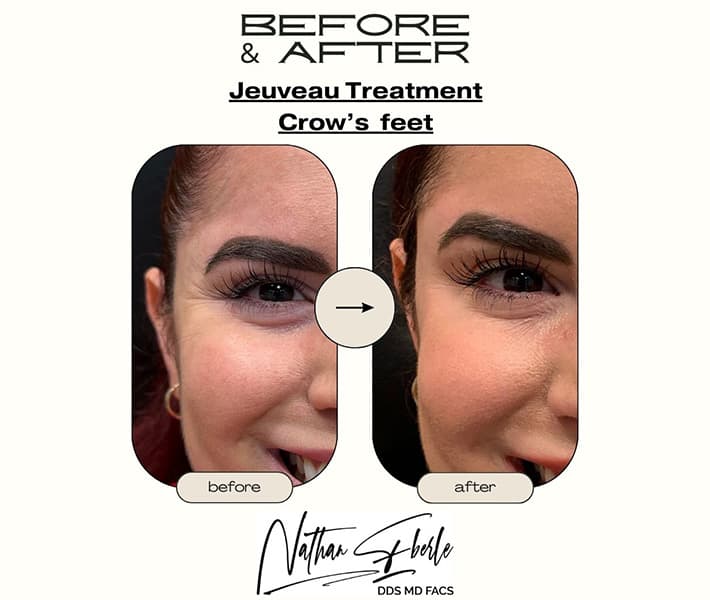Toxin before and after - Actual Patient
