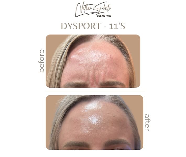 Toxin before and after - Actual Patient