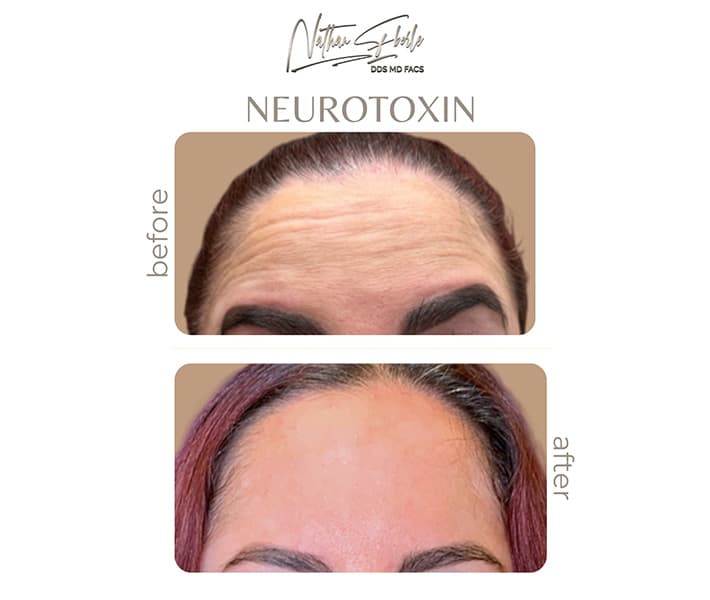 Toxin before and after - Actual Patient