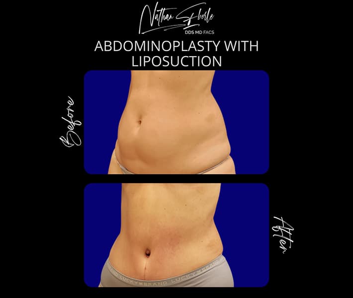Tummy Tuck before and after - Actual Patient
