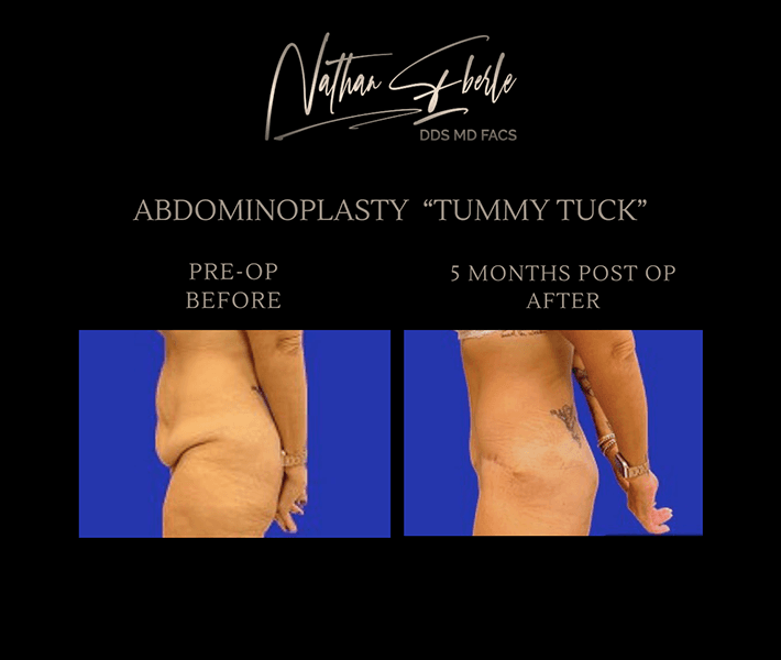 Tummy Tuck before and after - Actual Patient